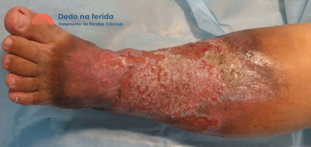 Alimentação anti-inflamatória para a saúde das veias