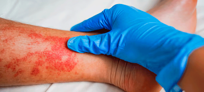 5 sinais de alerta da dermatite de estase venosa