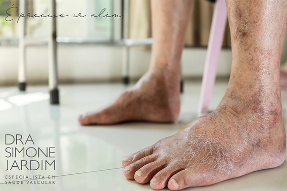 Alimentação anti-inflamatória para a saúde das veias