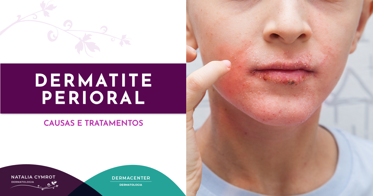 Como tratar a dermatite perioral