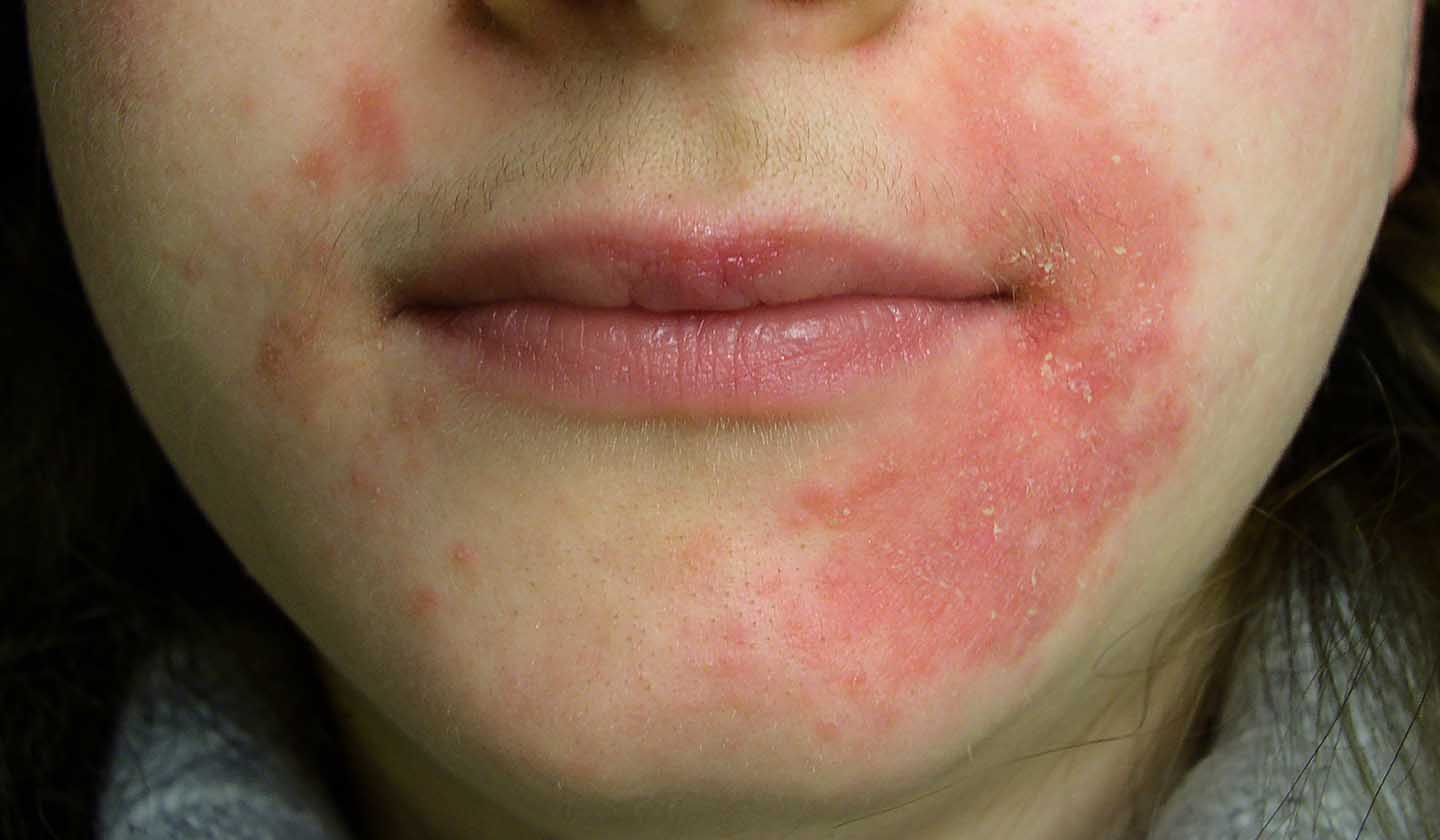 Alimentos que Pioram a Dermatite Perioral: Mitos e Verdades