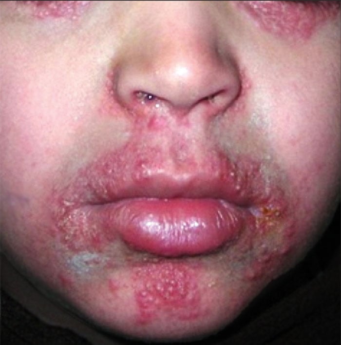 Dermatite Perioral vs. Rosácea: Como Diferenciar e Tratar