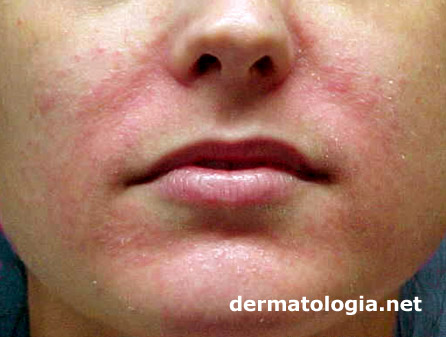 Os Melhores Ingredientes Naturais para Aliviar a Dermatite Perioral