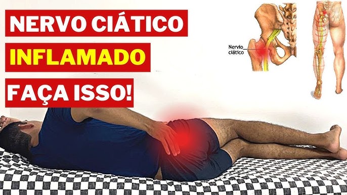 Como tratar a dor ciática
