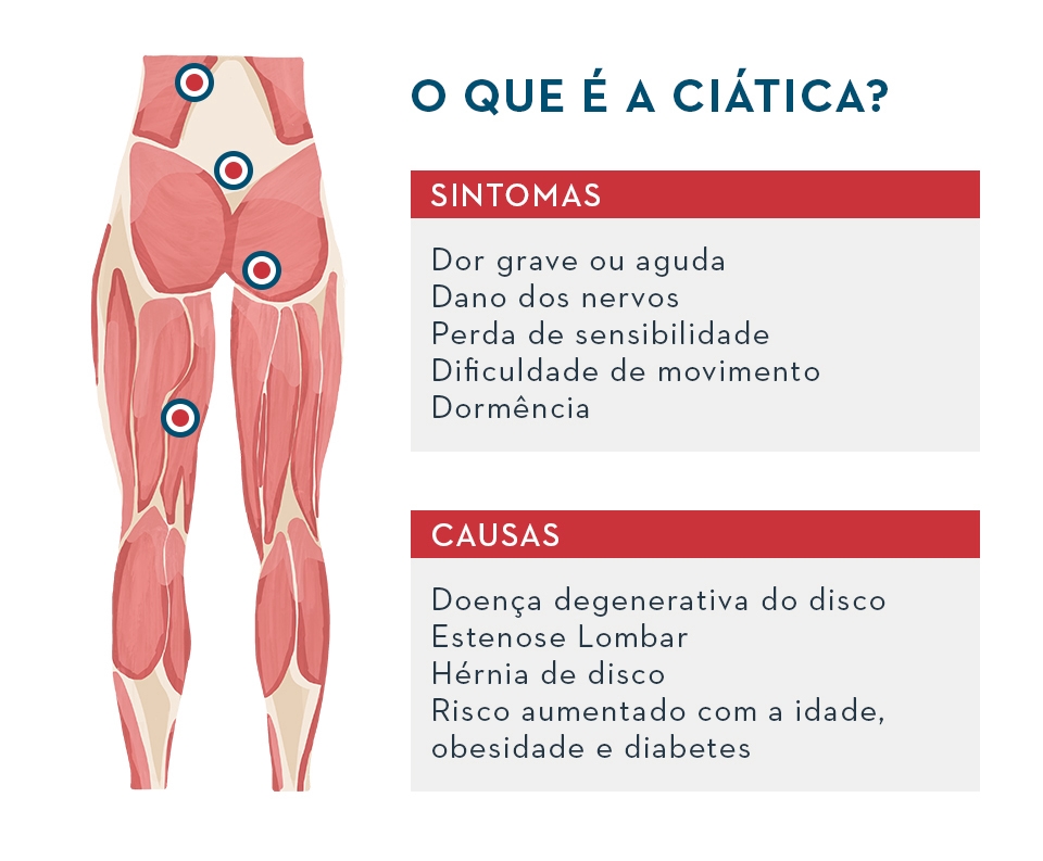 Como tratar a dor ciática