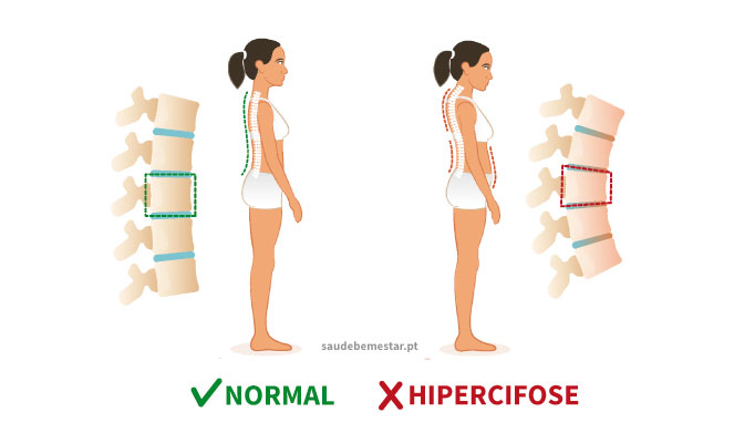 5 Exercícios de Pilates para Cifose