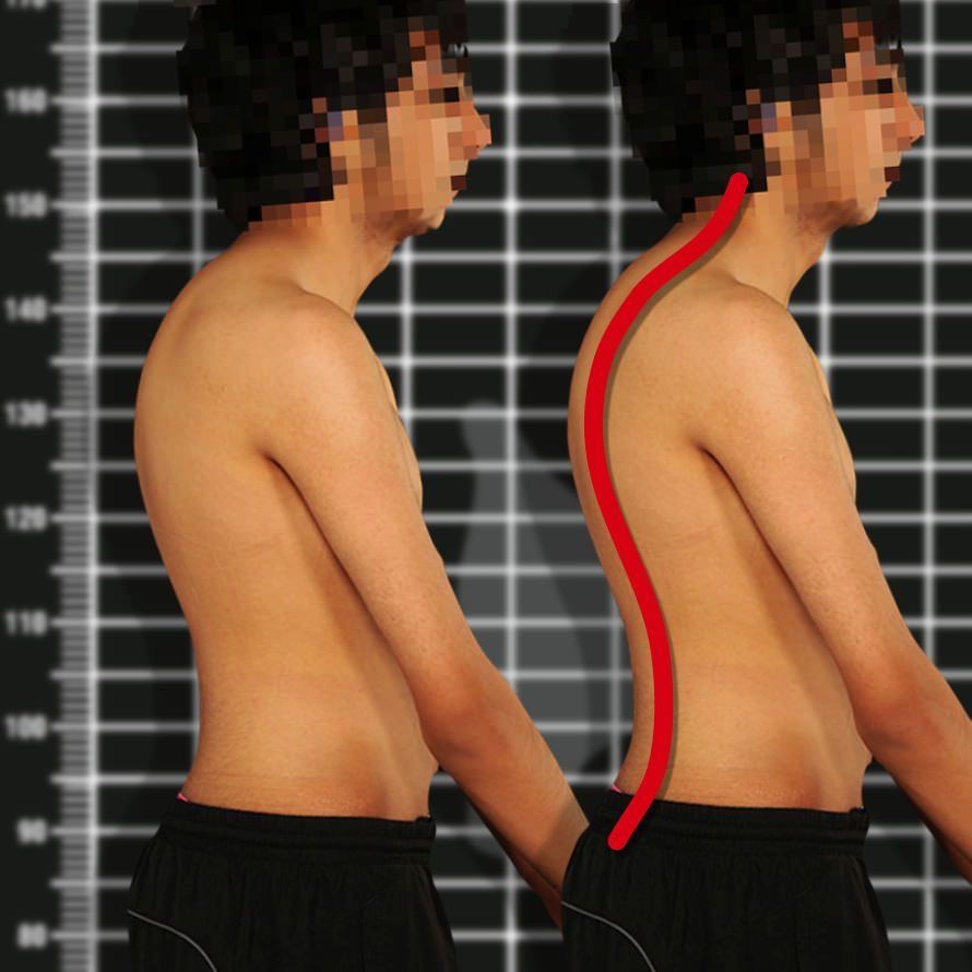 Entenda a Doença de Scheuermann e Seus Tratamentos