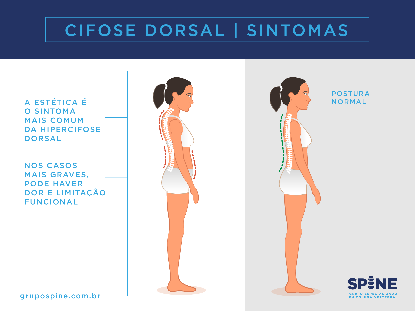 Como tratar a dor nas costas por cifose