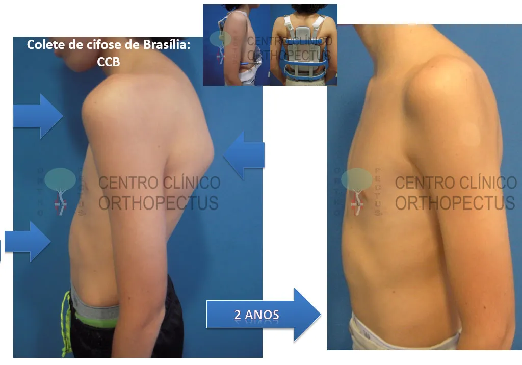 Como Dormir Corretamente com Dor nas Costas