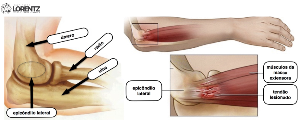 Como Identificar e Tratar o Cotovelo de Tenista
