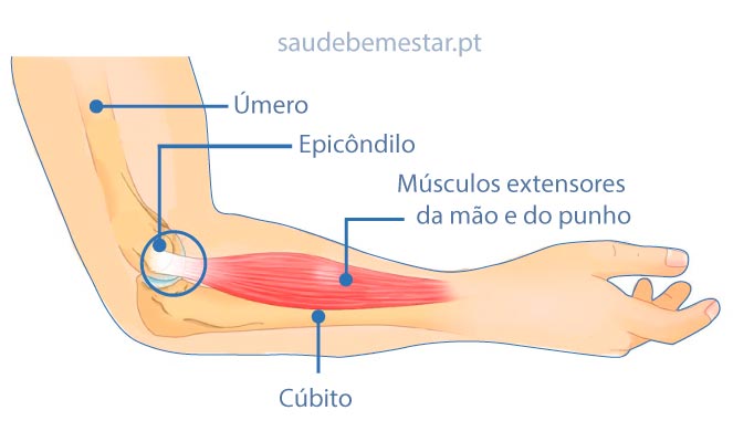 5 Exercícios Essenciais para Recuperação da Epicondilite