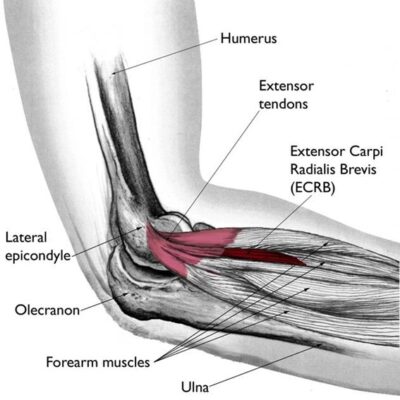 Prevenindo o Cotovelo de Tenista: Dicas Práticas