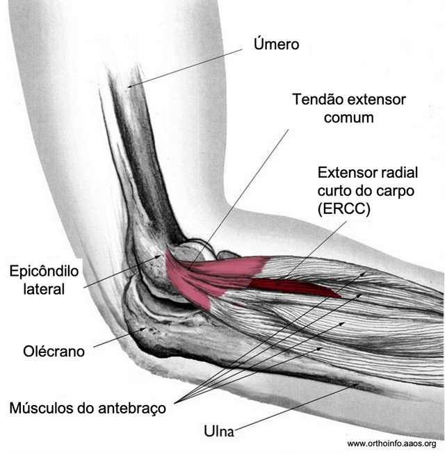 5 Exercícios Essenciais para Recuperação da Epicondilite