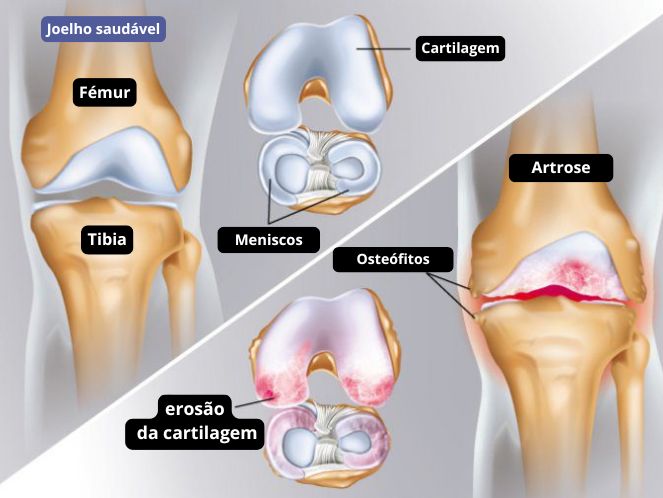 Como tratar a dor no joelho por artrose