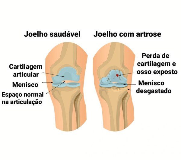 5 Exercícios Essenciais para Fortalecer o Joelho com Artrose