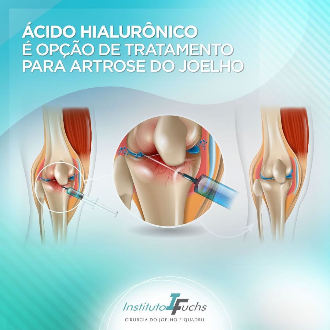 Como o Controle de Peso Impacta a Dor no Joelho