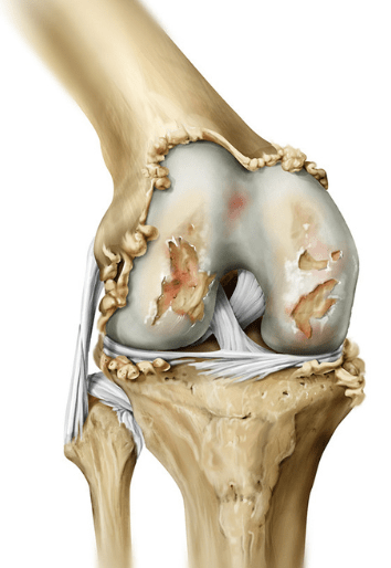 5 Exercícios Essenciais para Fortalecer o Joelho com Artrose