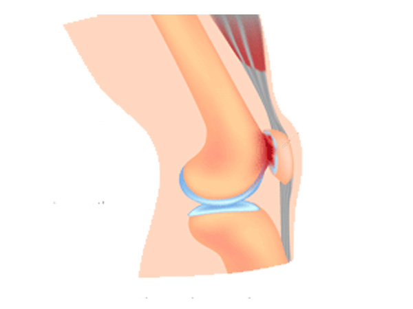 Acupuntura e Joelheiras: Terapias Complementares para Condromalácia Patelar