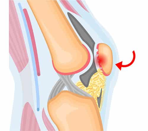 Quando a Cirurgia é a Única Opção para Condromalácia Patelar?
