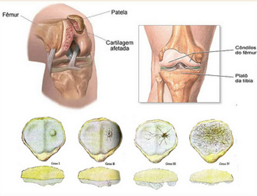 Como tratar a dor no joelho por condromalácia