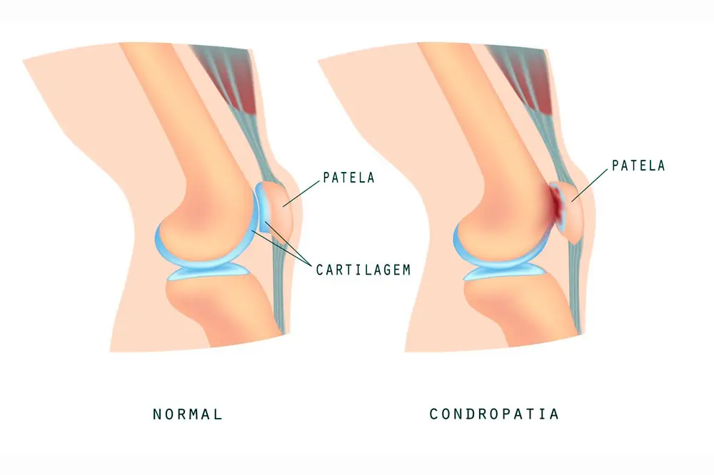 Como tratar a dor no joelho por condropatia