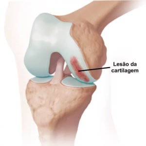 Guia Completo de Alongamentos para Aliviar a Dor Patelar