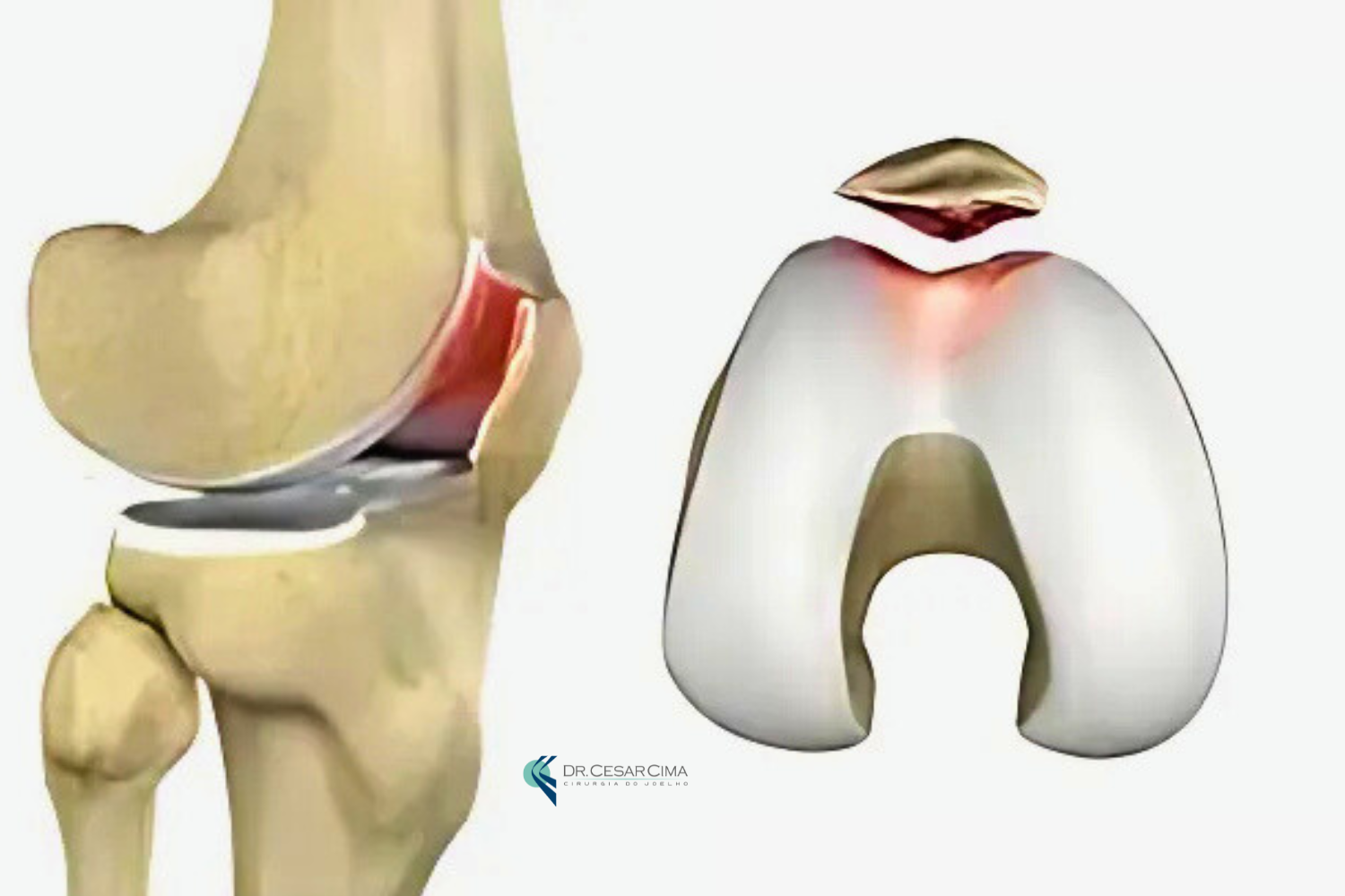 Guia Completo de Alongamentos para Aliviar a Dor Patelar