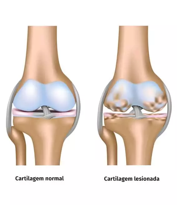 Como tratar a dor no joelho por desgaste da cartilagem