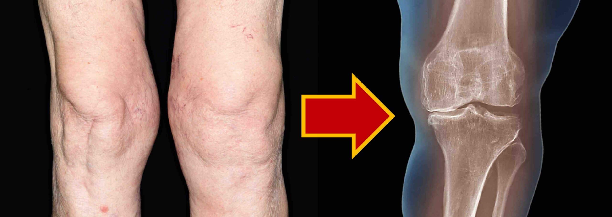 Alimentação Inteligente: O Que Comer Para Proteger Sua Cartilagem