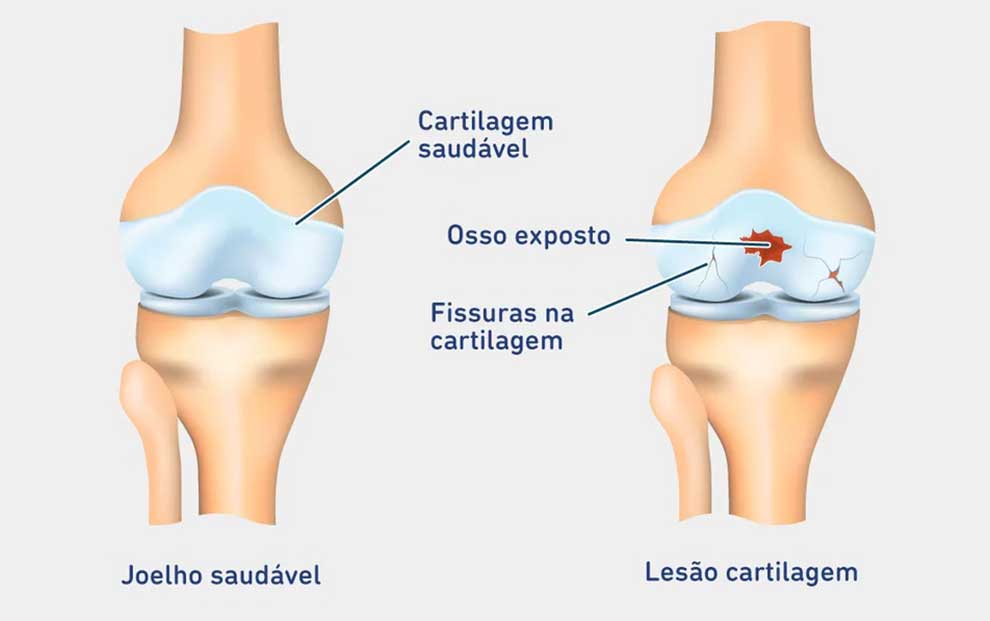 Fisioterapia para o Joelho: Quando Procurar e Quais os Benefícios