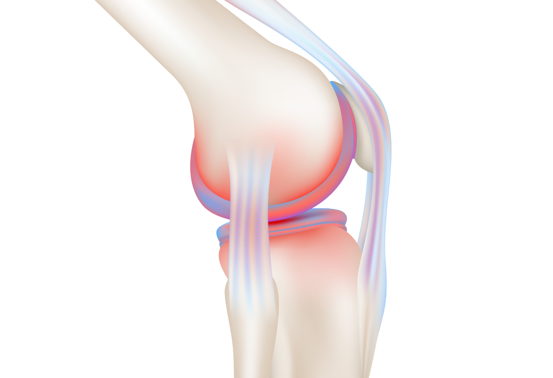 Infiltração no Joelho: Entenda a Viscossuplementação e Seus Efeitos