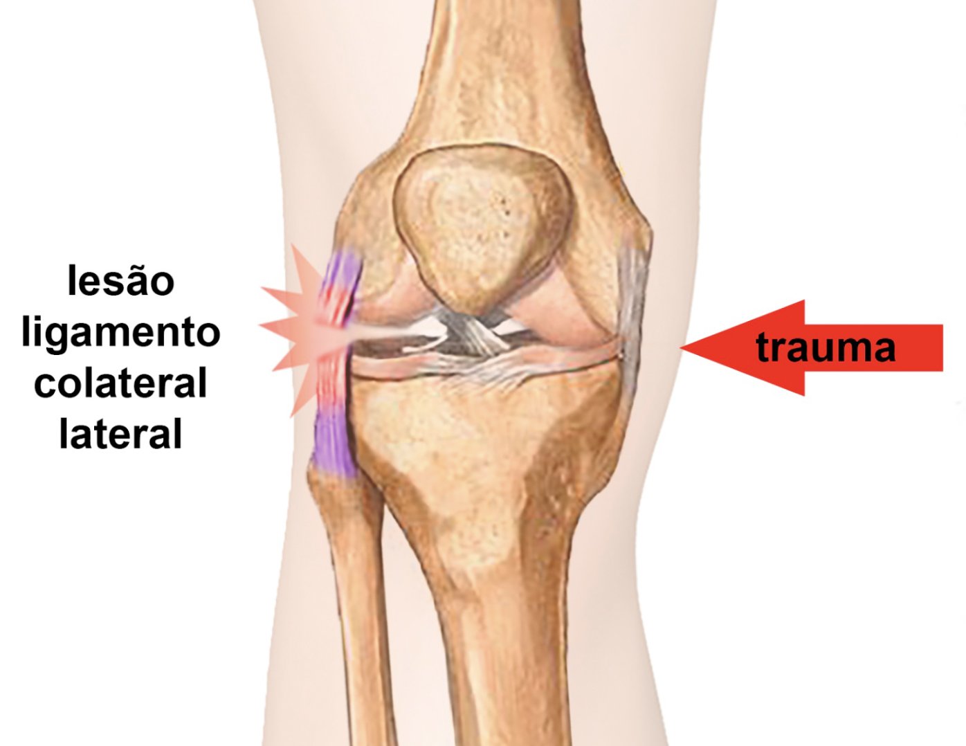 Como tratar a dor no joelho por lesão no ligamento colateral lateral