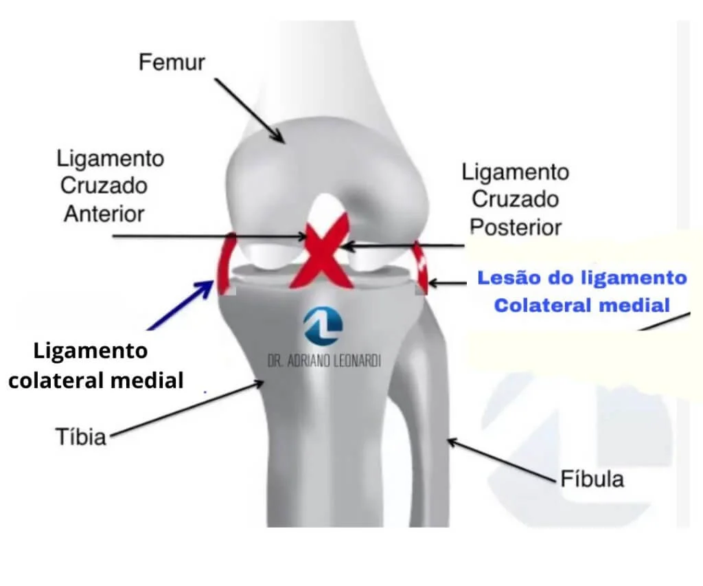 Graus de Lesão do LCL: Entenda as Diferenças