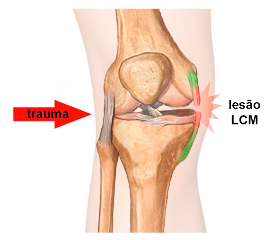 Como tratar a dor no joelho por lesão no ligamento colateral medial