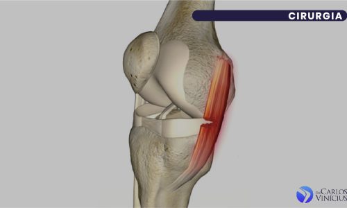 Entenda os Graus de Lesão do Ligamento Colateral Medial
