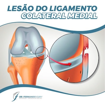 O Papel da Crioterapia no Tratamento Inicial da Lesão do LCM