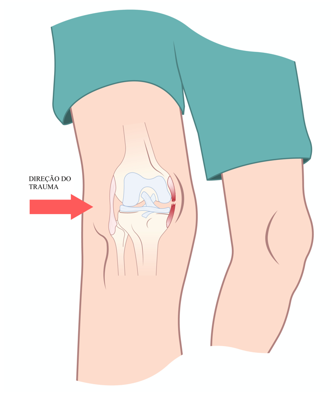 Como tratar a dor no joelho por lesão no ligamento colateral medial