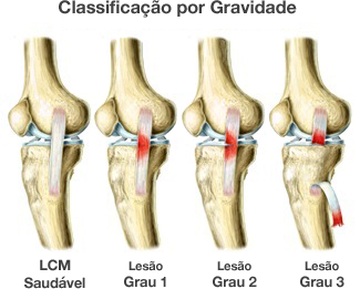 Como a Fisioterapia Acelera a Cura do LCM