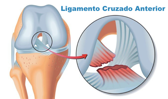 Como prevenir lesões no LCA