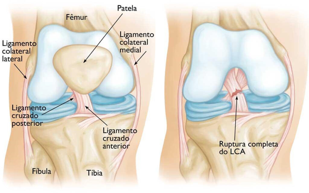 Quando a cirurgia de LCA é indispensável?