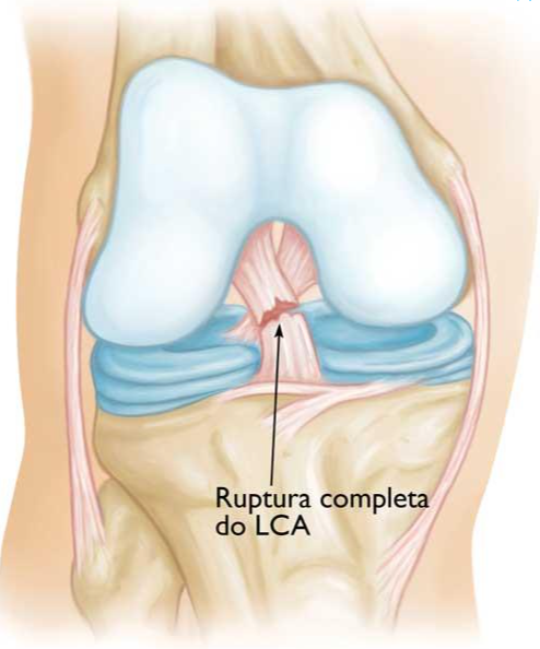 Exercícios de fortalecimento para o joelho