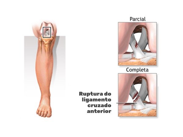 A importância da fisioterapia na recuperação do LCA