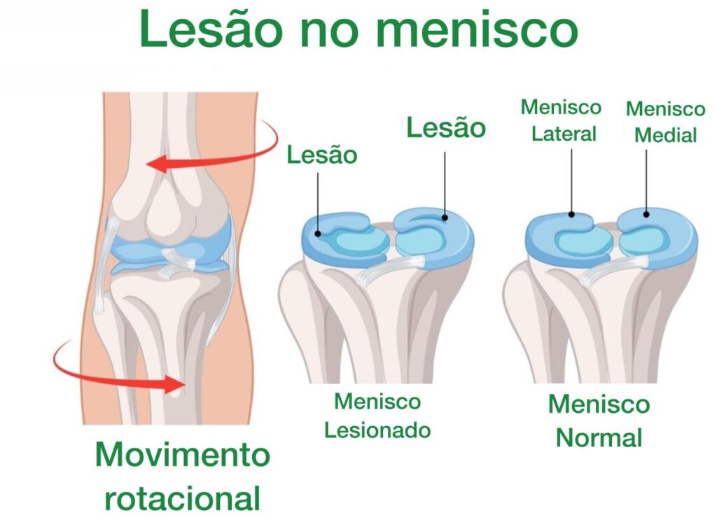 5 Exercícios Essenciais para Recuperação do Menisco