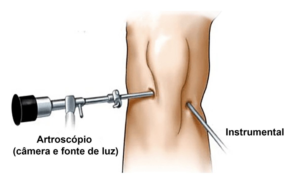 Quando a Cirurgia de Menisco é a Única Opção?