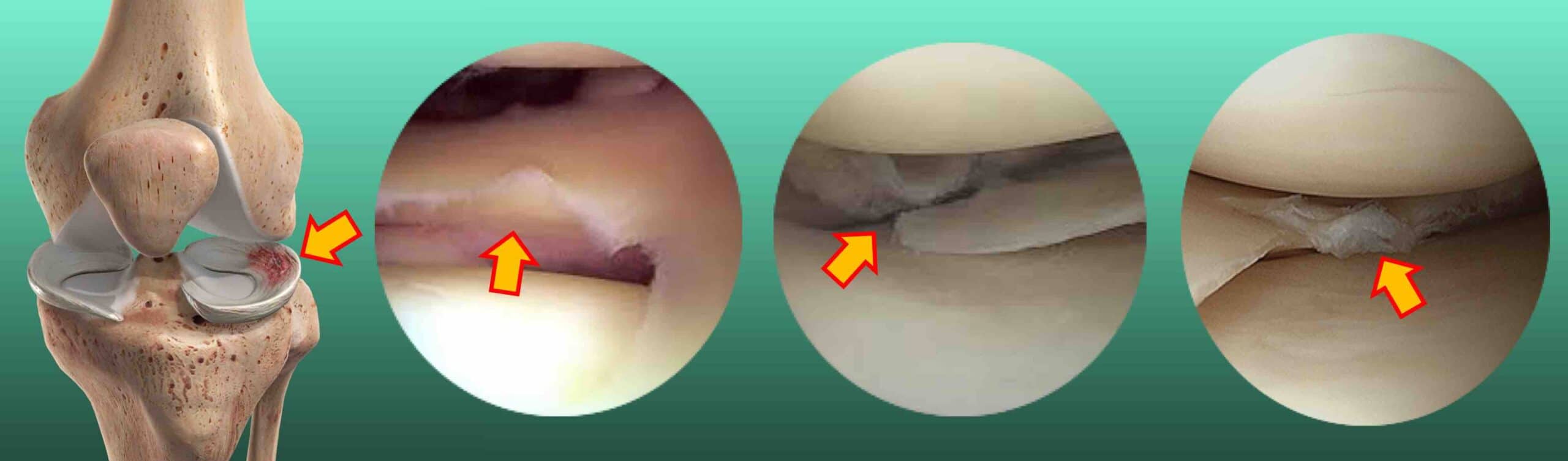 Como tratar a dor no joelho por lesão no menisco