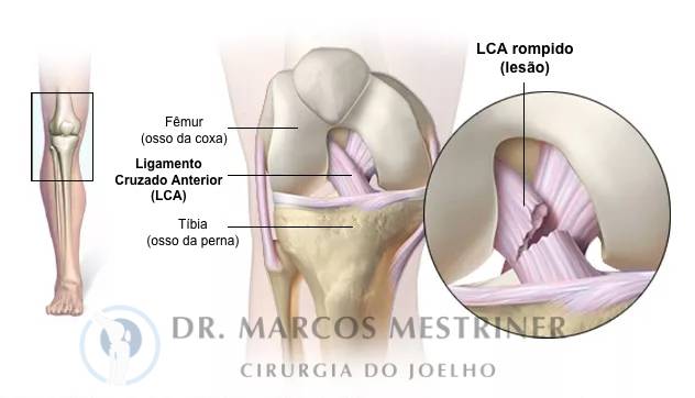 5 Exercícios Essenciais para Fortalecer o Joelho em Casa