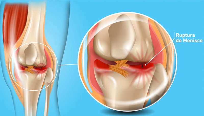 Quando a Cirurgia de Menisco é Realmente Necessária?