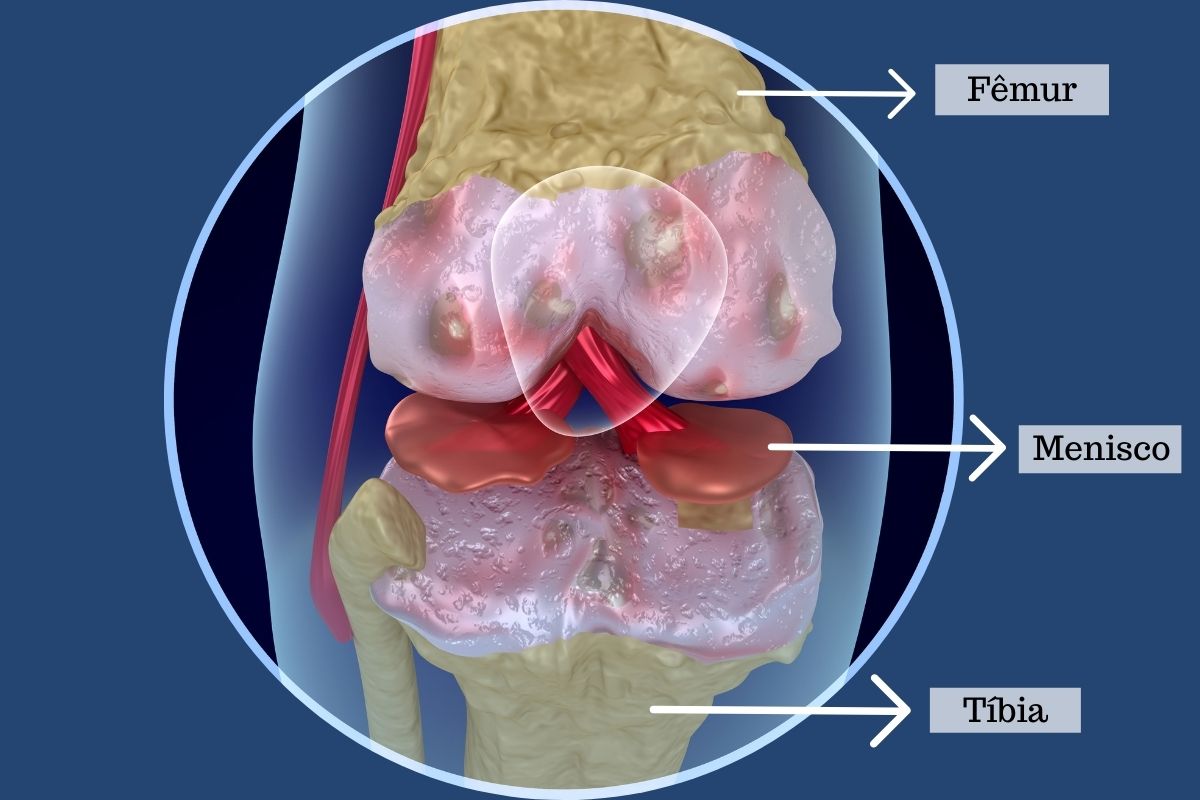 Guia Completo de Recuperação Pós-Artroscopia de Menisco