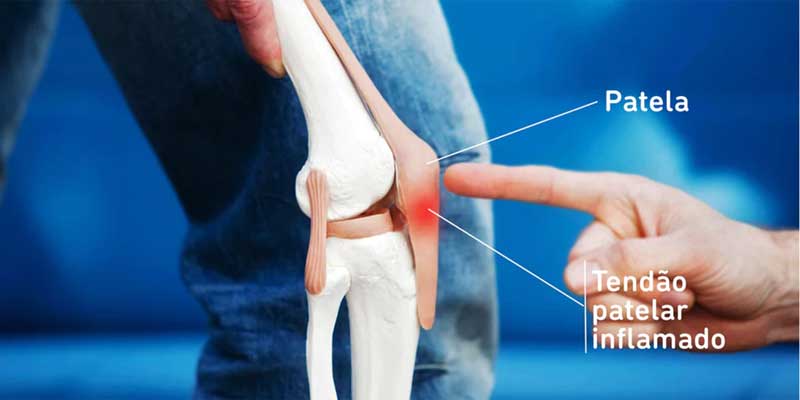 5 Exercícios para Aliviar a Dor no Joelho