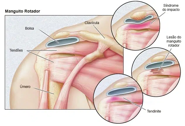 Como tratar a dor no ombro por lesão no manguito rotador